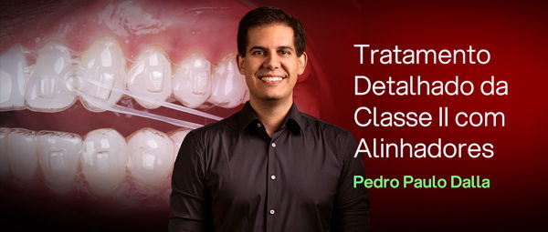 Tratamento Detalhado da Classe II com Alinhadores