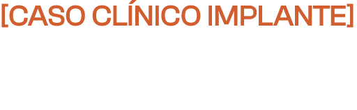 Caso Clínico Implante: Nobel com Regeneração Óssea Guiada Simultânea