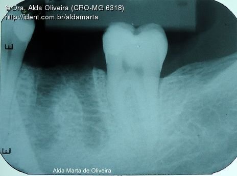 Descuido com a Saúde Bucal Gera Perda Dentária!!!