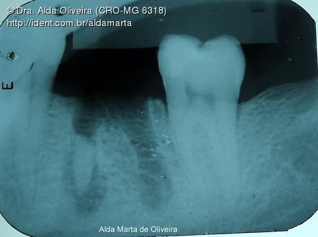 Descuido com a Saúde Bucal Gera Perda Dentária!!!