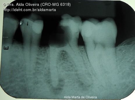 Descuido com a Saúde Bucal Gera Perda Dentária!!!