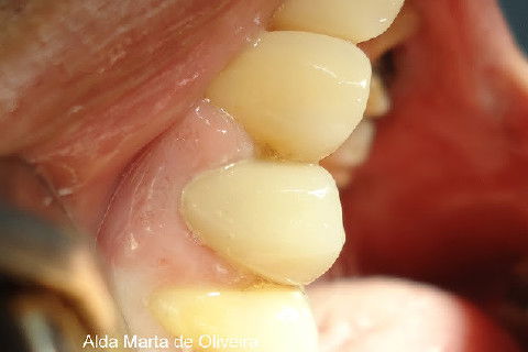 Reabilitação do Elemento 14