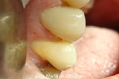 Reabilitação do Elemento 14