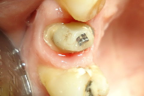 Reabilitação do Elemento 14