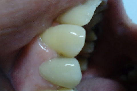 Reabilitação do Elemento 14