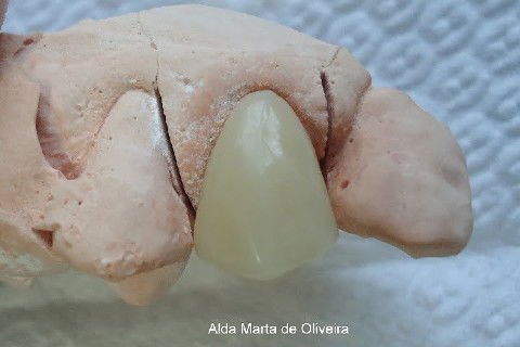 Reabilitação do Elemento 14