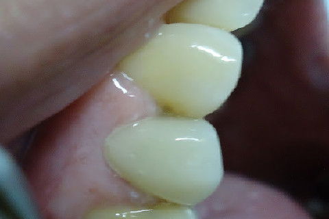 Reabilitação do Elemento 14