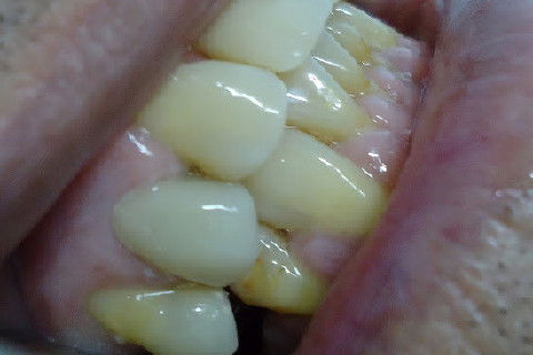 Reabilitação do Elemento 14