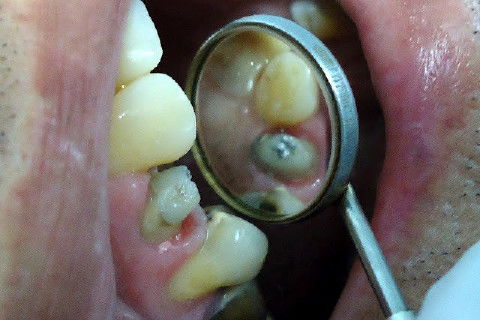 Reabilitação do Elemento 14