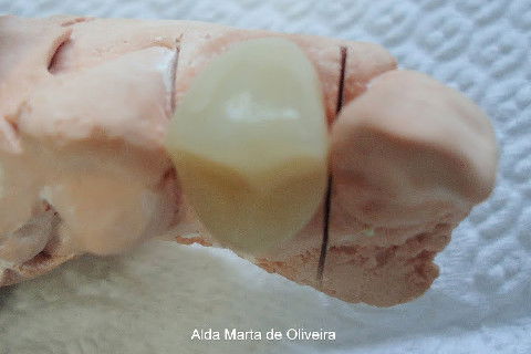 Reabilitação do Elemento 14