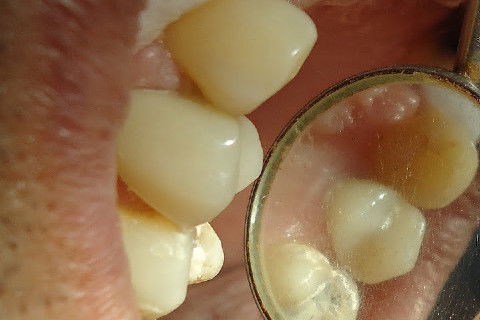 Reabilitação do Elemento 14