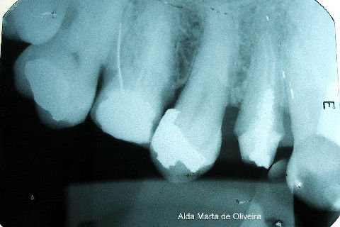 Reabilitação do Elemento 14