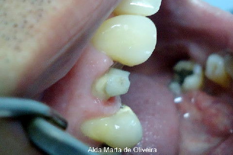 Reabilitação do Elemento 14