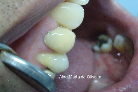 Reabilitação do Elemento 14