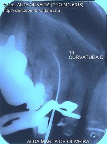 Tratamento Endodôntico Dente 13 com Curvatura Acentuada da Raiz