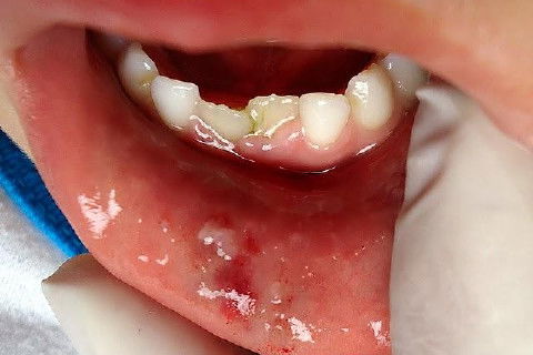 Concussão em Decíduos