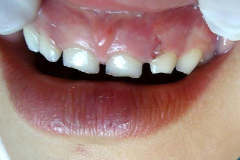 Concussão em Decíduos