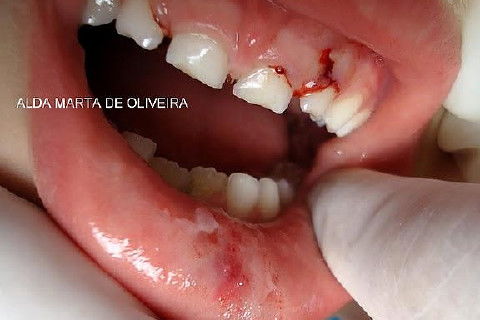 Concussão em Decíduos