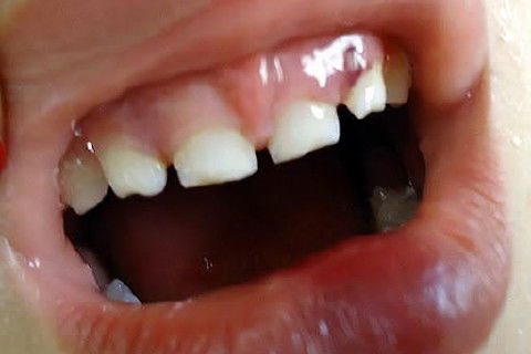 Concussão em Decíduos