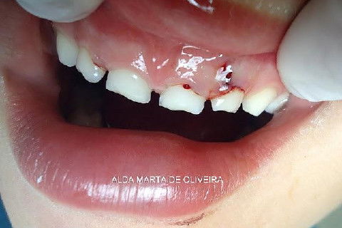 Concussão em Decíduos