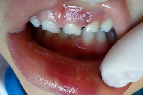 Concussão em Decíduos