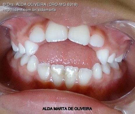 Dificuldade de Auto-Limpeza