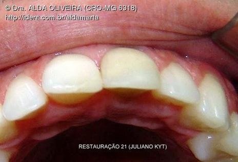 Reabsorção Externa Pós Trauma (2º Capítulo) Parte de Dentística