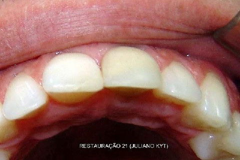 Reabsorção Externa Pós Trauma (2º Capítulo) Parte de Dentística