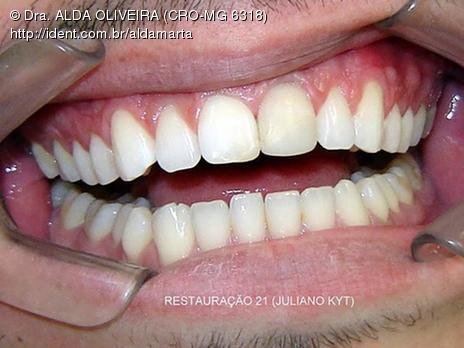 Ele se diz satisfeito com o resultado. Marquei mais um dia para mais um polimento. Tecnicamente nota-se uma diferença de cor entre o remanescente (que está muito escuro) e a restauração (que está na cor dos dentes adjacentes).