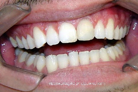 Ele se diz satisfeito com o resultado. Marquei mais um dia para mais um polimento. Tecnicamente nota-se uma diferença de cor entre o remanescente (que está muito escuro) e a restauração (que está na cor dos dentes adjacentes).
