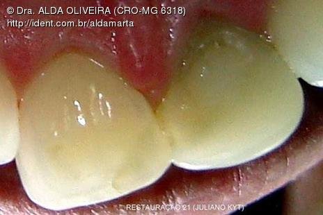 Reabsorção Externa Pós Trauma (2º Capítulo) Parte de Dentística