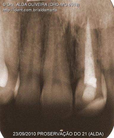 Hoje o Dr. Juliano Kyt enviou-me uma radiografia de controle do caso, postei-a em sépia para melhor visualização. Êta dentinho judiado, viu?