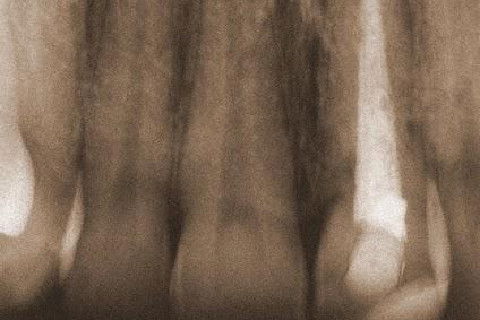 Hoje o Dr. Juliano Kyt enviou-me uma radiografia de controle do caso, postei-a em sépia para melhor visualização. Êta dentinho judiado, viu?