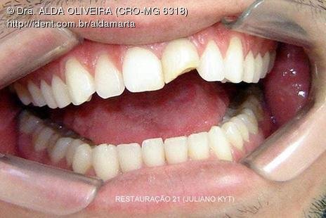 (e-mail que o Dr. Juliano Kyt me enviou) Boa tarde Alda, Hoje fizemos o dente 21 do seu paciente. Procurei seguir aquilo que você me pediu. Fui bem conservador.