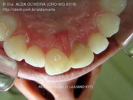 Reabsorção Externa Pós Trauma (2º Capítulo) Parte de Dentística