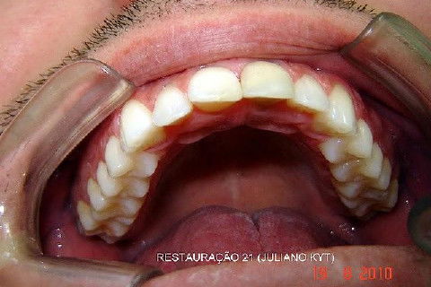 Poderia ficar melhor se já com a presente reconstrução fizéssemos na vestibular um preparo para faceta, que poderia ser direta com resina para menor desgaste ou para ficar perfeito um maior preparo para faceta de porcelana metal free.