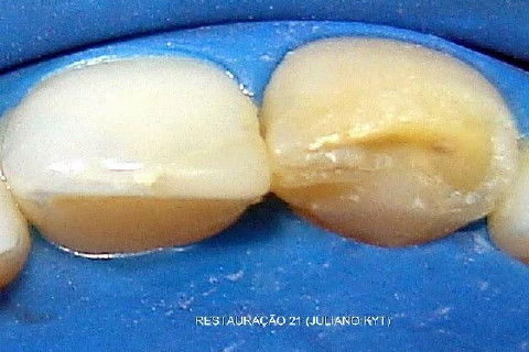 Reabsorção Externa Pós Trauma (2º Capítulo) Parte de Dentística