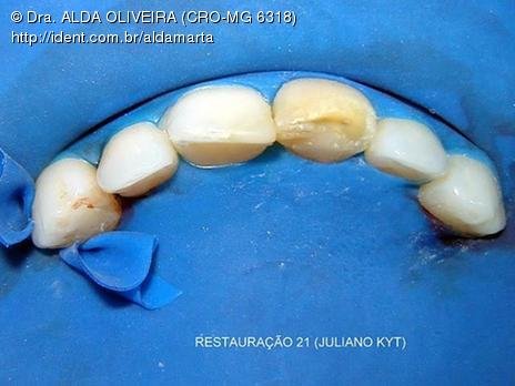 Reabsorção Externa Pós Trauma (2º Capítulo) Parte de Dentística