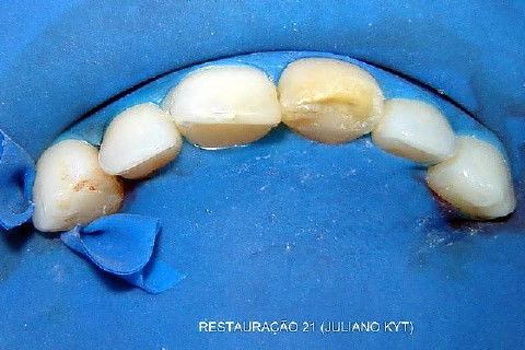 Reabsorção Externa Pós Trauma (2º Capítulo) Parte de Dentística