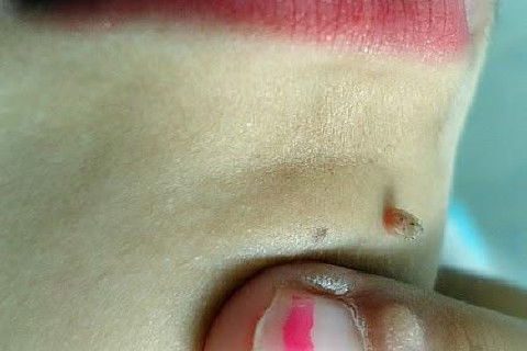 Infecção pelo Hpv [2]