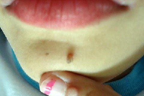 Infecção pelo Hpv [2]