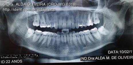 Cirurgia de Siso Incluso