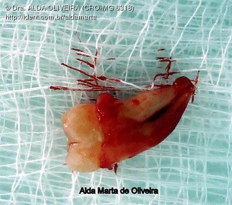 Cirurgia de Siso Incluso