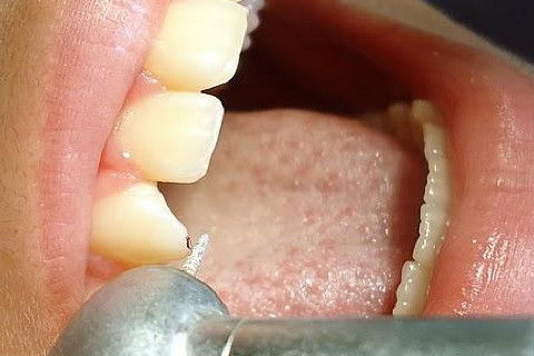 Pericementite Traumática Elemento 13