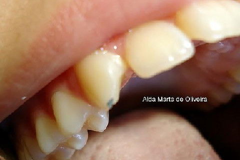 Pericementite Traumática Elemento 13