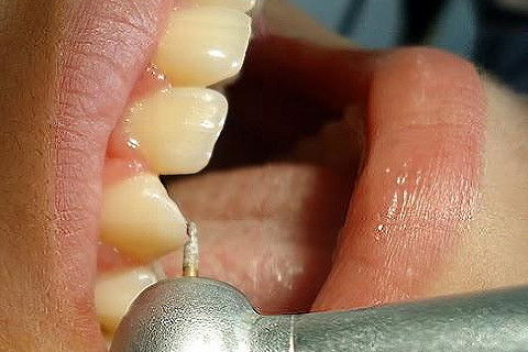 Pericementite Traumática Elemento 13