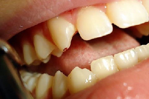 Pericementite Traumática Elemento 13