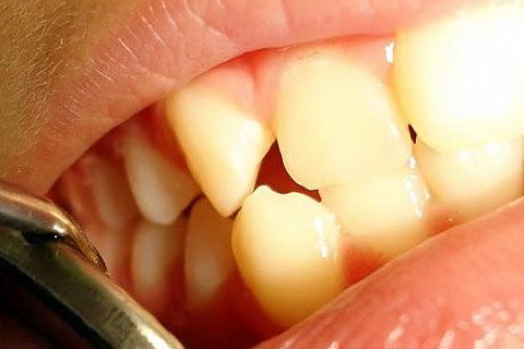 Pericementite Traumática Elemento 13