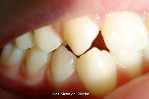 Pericementite Traumática Elemento 13