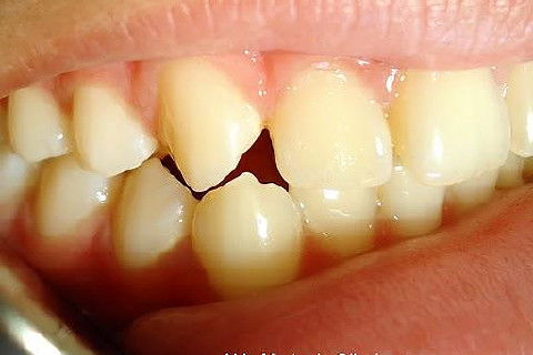 Pericementite Traumática Elemento 13